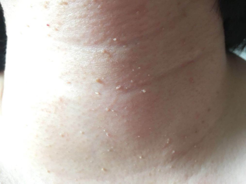 「饮食」脖子上的小肉疙瘩是什么？不仅影响美观，还可能存在这些健康隐患