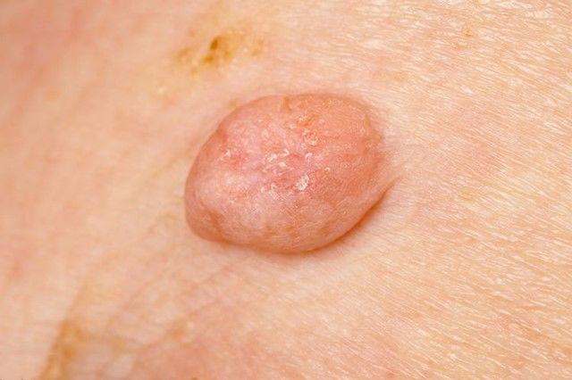 医生|皮肤上的小肉球能抠掉吗？会癌变吗？医生来揭秘了，乱抠早晚出事