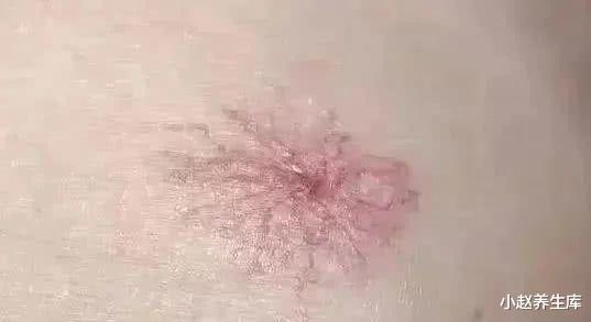 『肺癌』双脚的后脚跟，粗糙、起皮、干裂，可能是肝脏引起的，别忽视