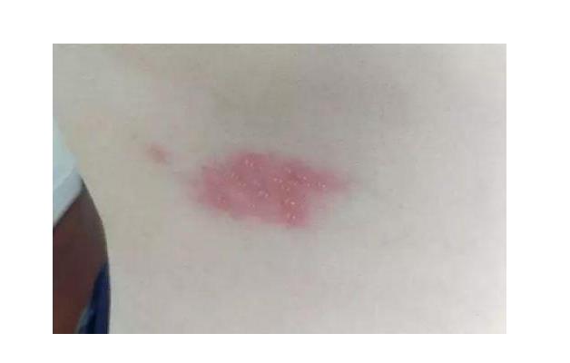 『痘痘』火龙缠腰，缠一圈会出人命？这句话可靠吗？医生对此说出了实话！