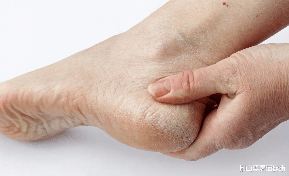肝脏|肝好不好，看手脚便知道！手脚出现6异常，小心肝病找上门