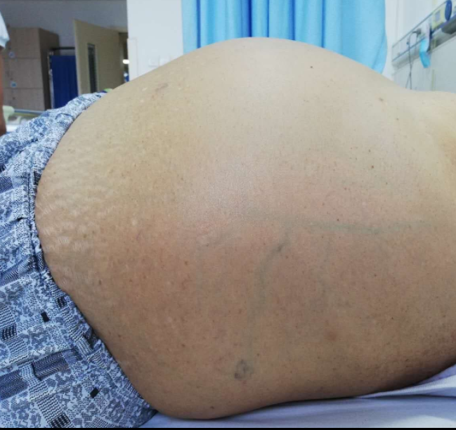 肝硬化|一旦皮肤上出现这种红痣，十有八九是肝硬化，最好检查一下