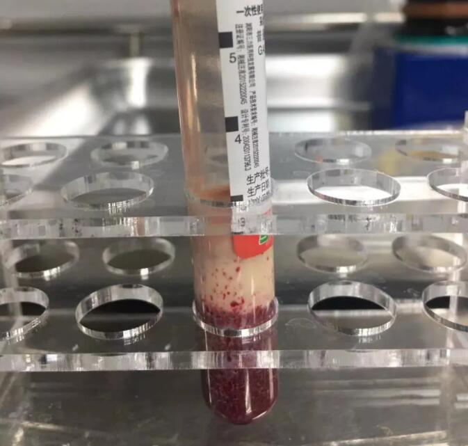 西方日记 22岁女子长期过量喝奶茶，突然昏迷被送进ICU：血液都几乎成了“奶茶”