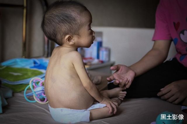黑土影像|广东一岁男婴“肚大如球”奔赴千里之外求医，医院给的结果太吓人