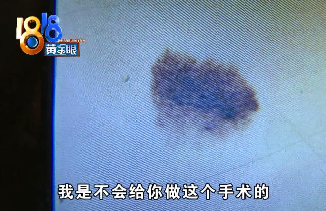 |17岁女儿脖子上有胎记，妈妈想通过手术去除，结果肠子悔青