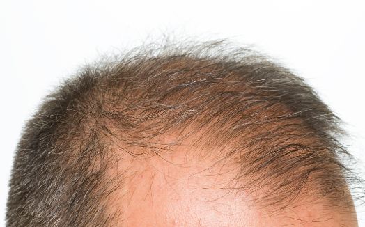 [肝脏]一旦头发有4个表现，十有八九是肝出问题了，抓紧养护肝脏吧