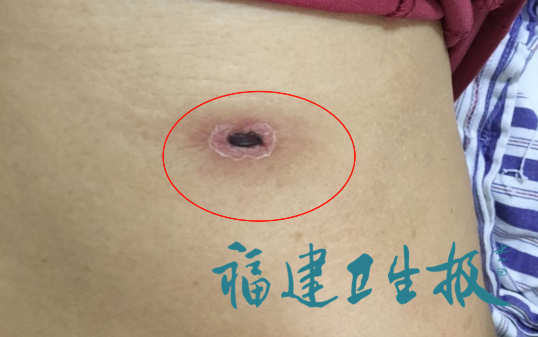 浙样的生活|女子因虫子发热一周，这虫子还有来历，别来无恙的“恙”指的是它