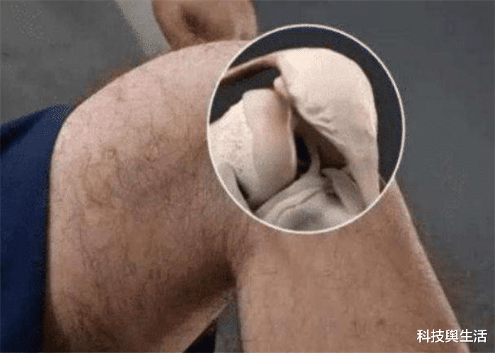 科学家▲人身体淘汰已久的骨头，如今又再次出现，究竟是退化还是进化？