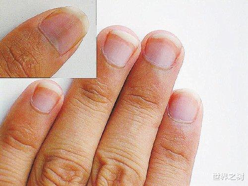 ##人体出现这样的指甲，要当心身体病变