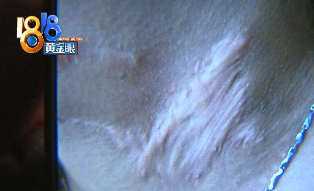 |17岁女儿脖子上有胎记，妈妈想通过手术去除，结果肠子悔青