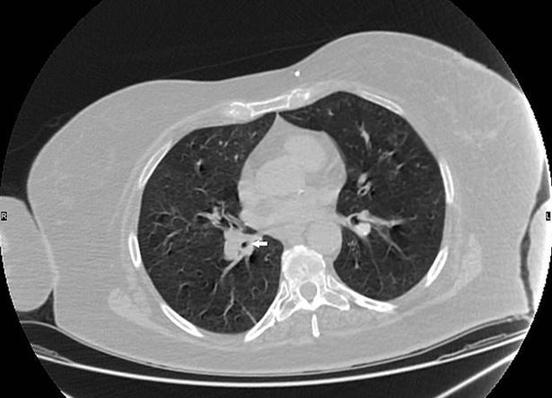 睹图|女子做完手术后被要求核酸测试，结果拭子进肺里又做手术取出