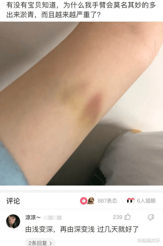 |“女生:为什么我的手臂会莫名其妙出现这么多淤青,而且越来越严重?”网友的回复给我都看懵了!
