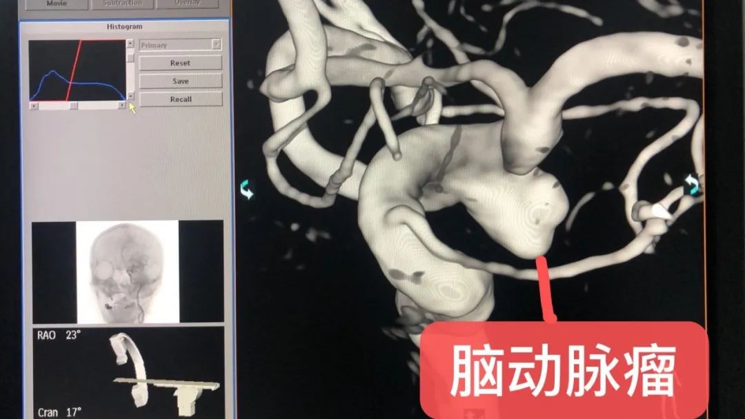 浙江老年报|这个病很凶险！杭州大妈洗衣突然倒地失去知觉……