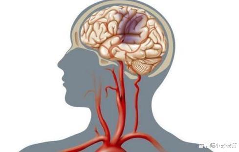 脑梗塞▲身体出现5种表现，小心脑血管堵了，养好血管，谨记“2少3多”
