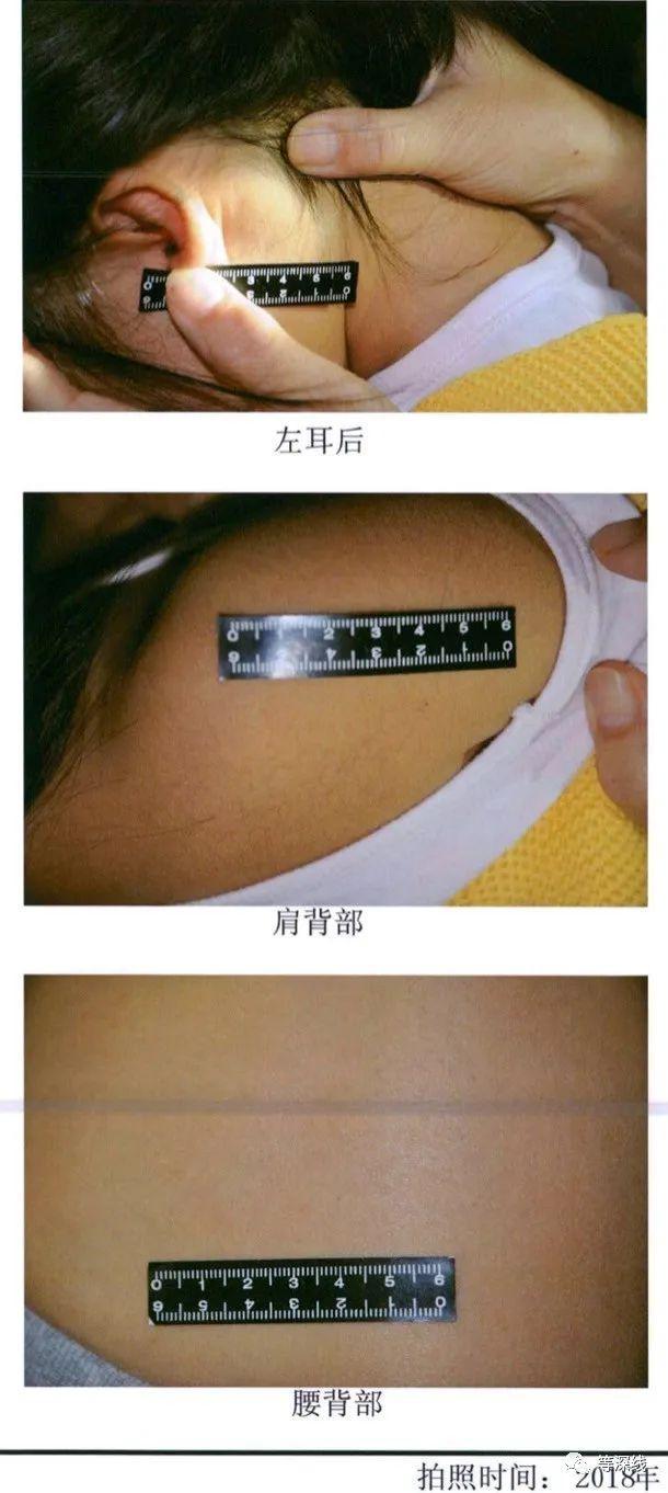 环球时报|天津金色摇篮幼儿园针扎虐童案审判:5名幼师均获刑