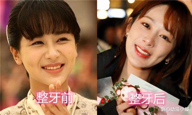 唐艺昕■有种“逆袭”叫整牙后，杨颖、唐艺昕变美，可看到她：还不如不整
