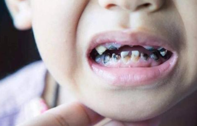 医生|6岁的女儿天天刷牙，却满嘴“小黑牙”，医生：都是无知惹的祸