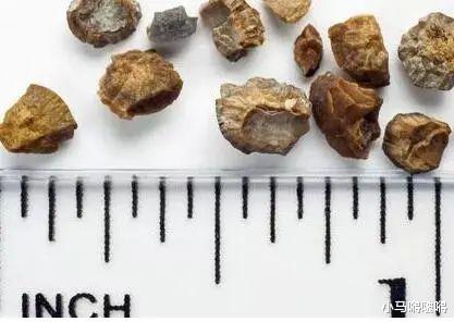 「尿毒症」49岁男子，腰痛检查，确诊尿毒症，一种水喝太多，肾都伤透了