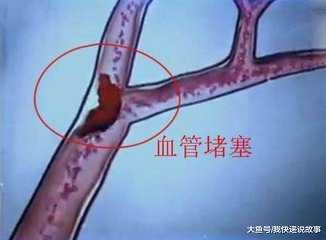 [肺栓塞]体内有没有血栓，看看你的手和脚就知道，别错过了！