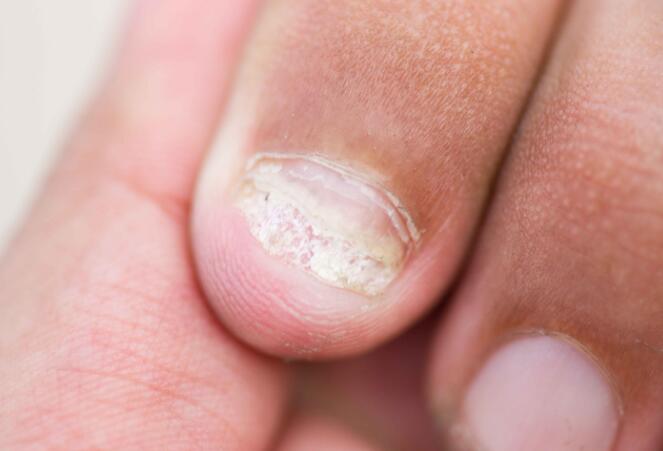 肝癌|肝癌来临前,身体会释放出4个“信号”,手脚变化尤为明显