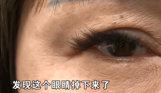 衰老|6万整形眼睛掉了？女子坚称“不割”遭无视，医院：只能尽量放正