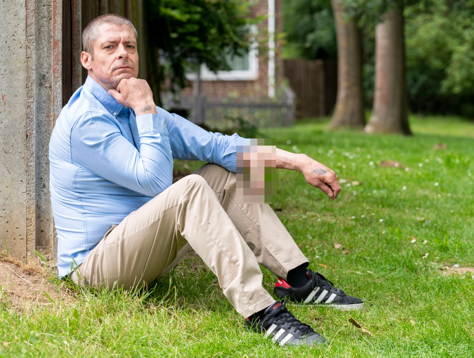 医生|英国老哥感染后丁丁脱落，医生给他在手臂上种了个新的…这都行？