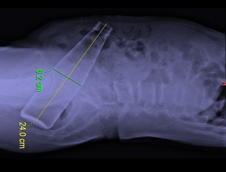 热点趣事 难以启齿的手术：河南奇葩男子把一个24CM玻璃瓶塞进肛门里，自取一个晚上未果羞愧送医