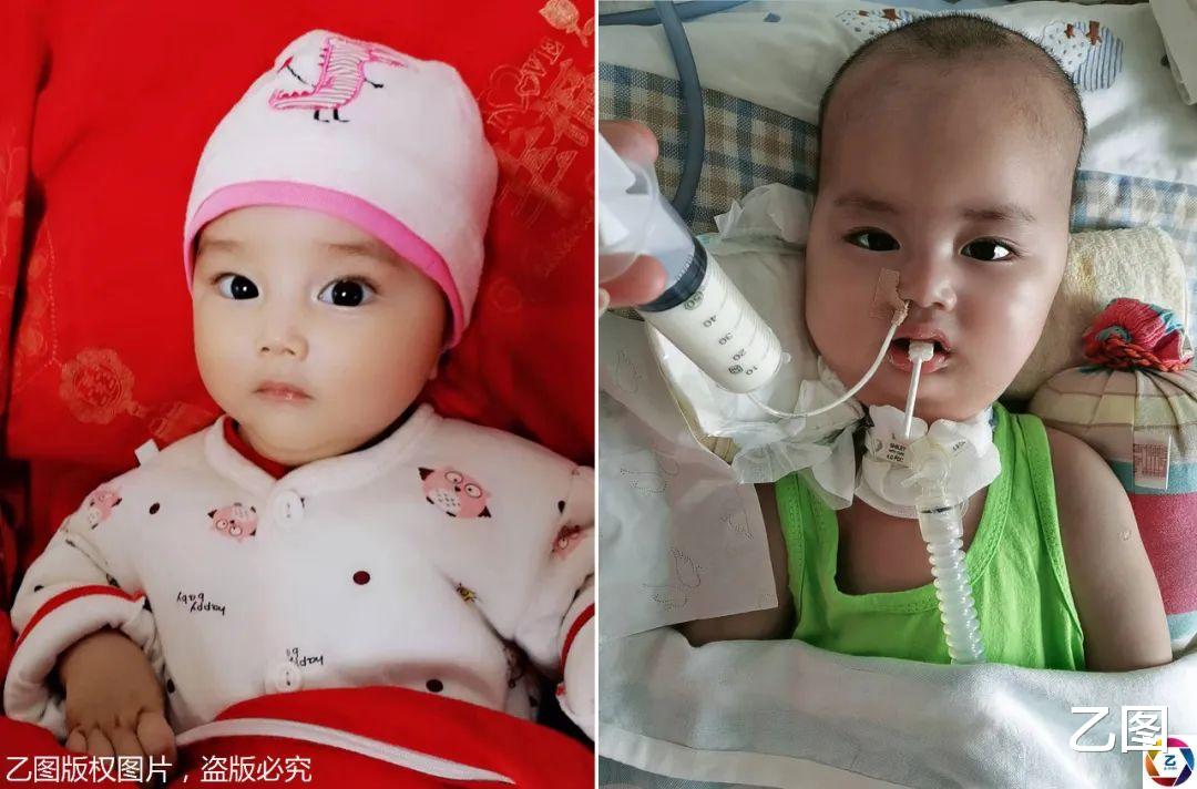 #诺西#一岁大眼男童患罕见病，只有眼珠能动，天价救命药70万元一针