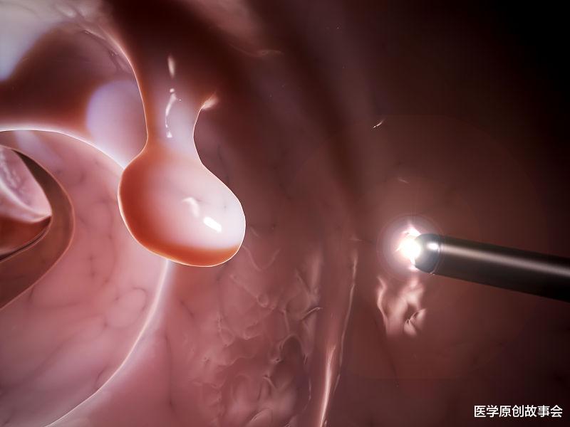 癌细胞|癌症是拖出来的，医生忠告，远离癌细胞，三种息肉最好及时切除