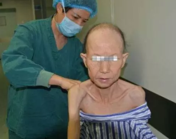 「皮肤病」男子错把艾滋病当皮肤病，不幸感染，若皮肤有3种变化，尽快查！