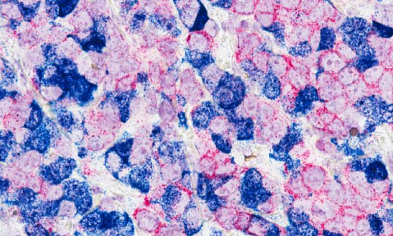 乳腺癌|新研究揭示了某些晚期乳腺癌患者的最佳药物选择