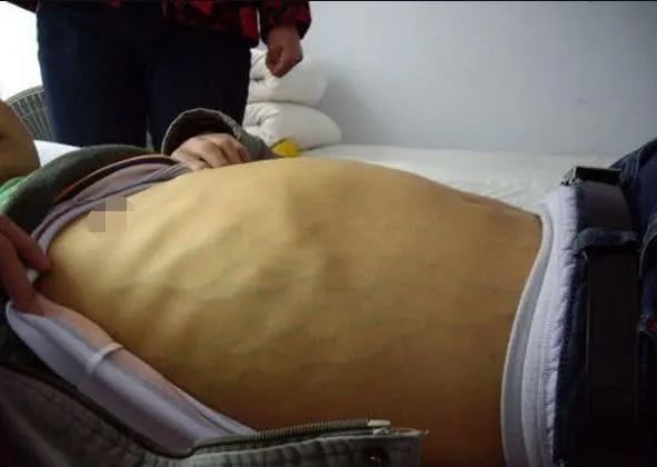 肝脏@42岁夫妻俩,全身发黄,提醒:三种东西早扔掉,别舍不得