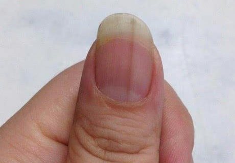 「」指甲上出现“竖纹”，是身体出现了状况？医生说出了实情！