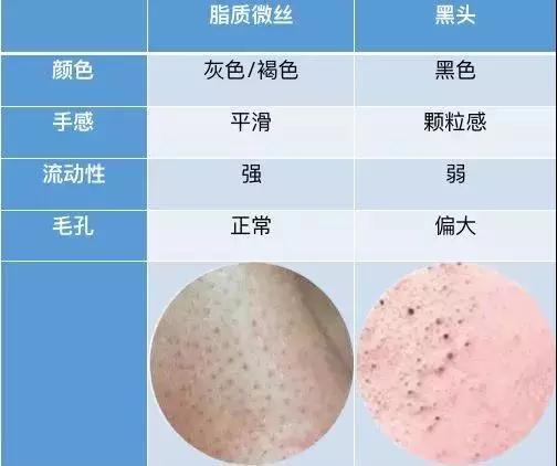 黑头|鼻翼毛孔里的黑色东西是黑头？脂质微丝？