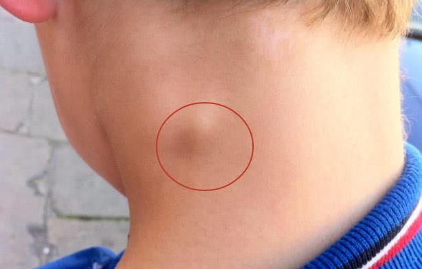 『肺癌』癌症体质，身体会有3个特征，想藏都藏不住！