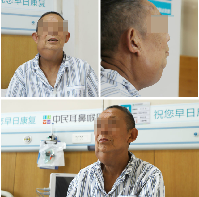「肿瘤」中民成功切除罕见之咽旁颈深部肿瘤