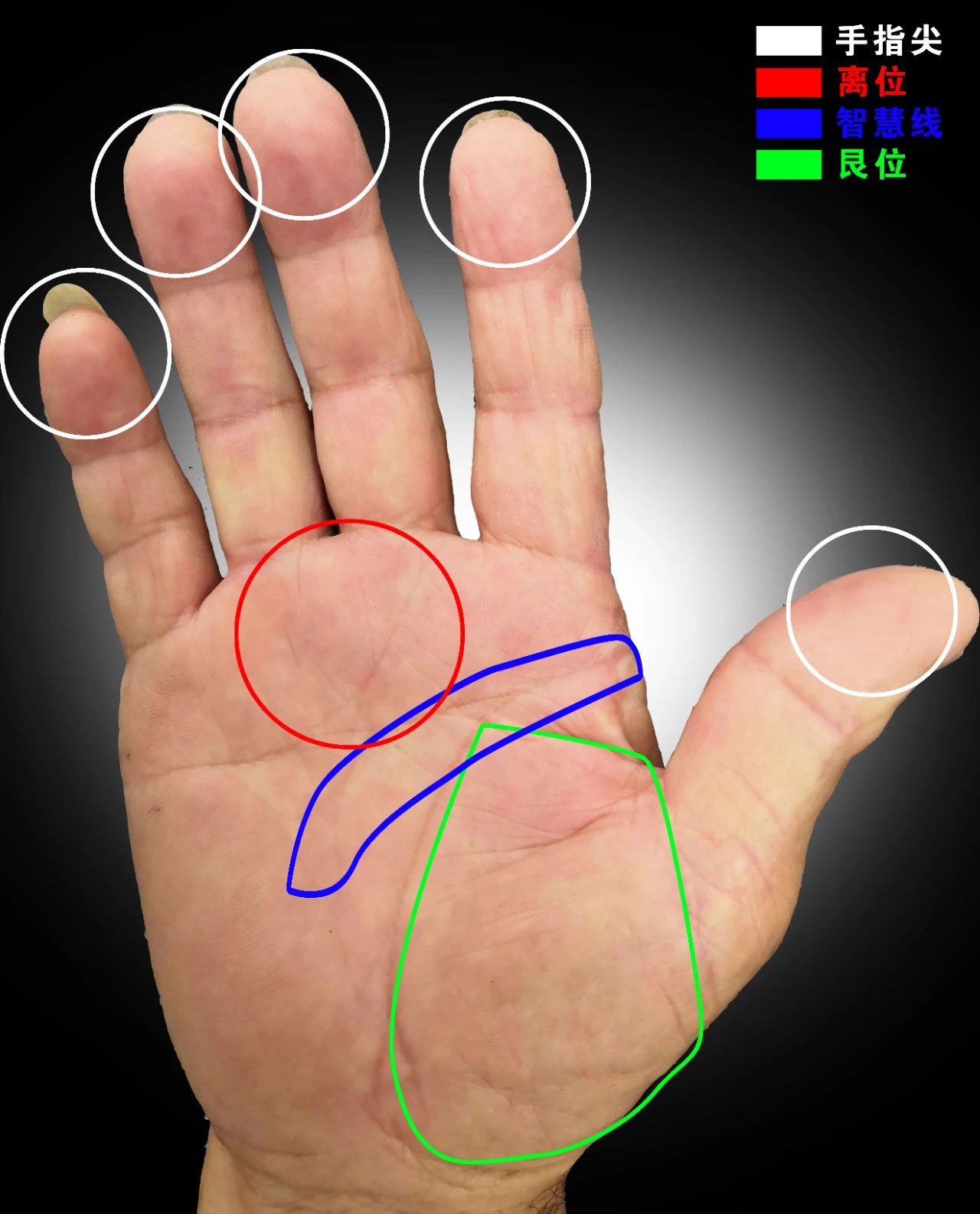 『中风』中风 | 人类第一杀手，查查自己手上有没有符号