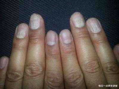 贫血@指甲上面有“竖纹”到底是怎么回事呢?, 或许是这4种状况在捣鬼