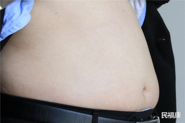 失眠|脂肪越少越好吗？哪里的脂肪是多余的？医生：不能小瞧脂肪的作用