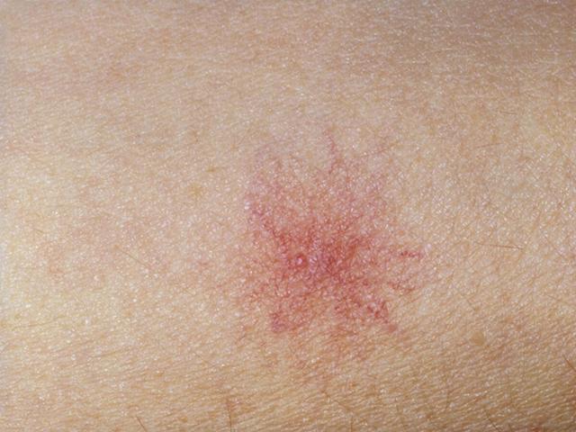 肝癌|肝内有癌细胞？皮肤先知，皮肤出现“2黑2痣1痒”，肝癌已登门