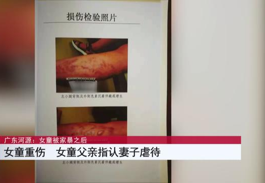 『河源』女童惨遭生母殴打入院，医生：再晚将危及生命！