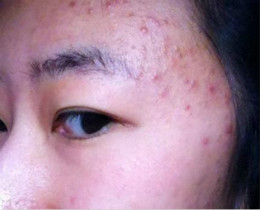 #痤疮#长在头皮上的“痘”不是青春痘，可能是难缠的三种病！