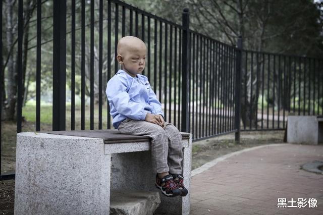 黑土影像|4岁男童眼中长“脏东西”把一只眼球冲破，另一只眼恐怕也保不住