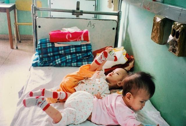 睹图|连体女婴经过10小时手术成功分开，17年后姐妹俩都考上大学