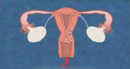 宫颈癌|宫颈癌并不是悄无声息, 一旦内裤出现这种异常, 十有八九是大病!