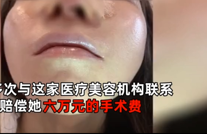 整形|北京一演员花6万7整形，术后3天鼻尖多出一个洞，护士：只是结痂