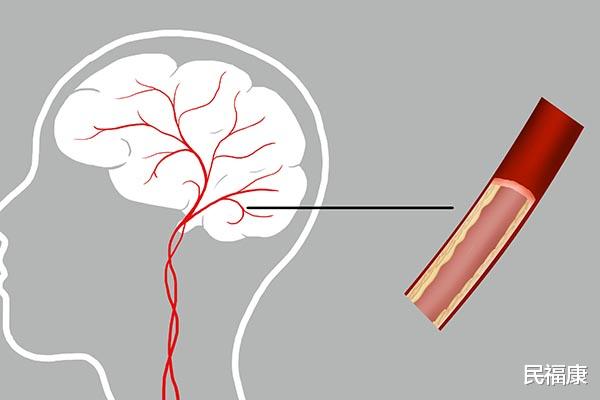 肿瘤|脑供血不足不可怕，坚持吃3样食物，保护血管，痴呆不来找
