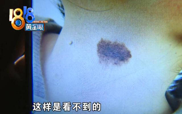 |17岁女儿脖子上有胎记，妈妈想通过手术去除，结果肠子悔青
