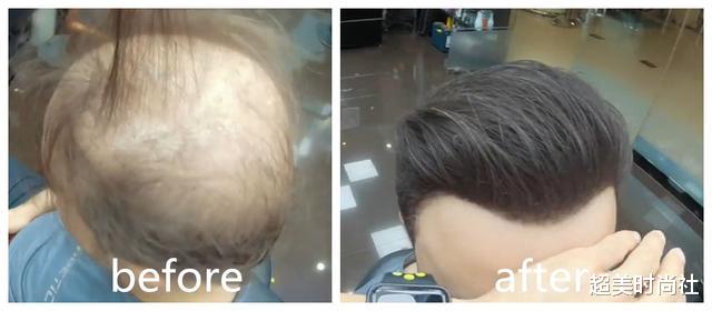 短发|脱发的救星来了！迪拜理发师给秃顶做造型，不用假发也变得很茂密