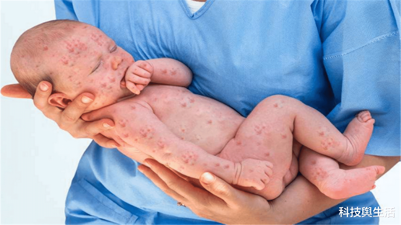 |曾肆虐全球的病毒，后来被人类消灭，为何仍有活体保存在实验室？